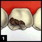 Step 1 Dental Crown