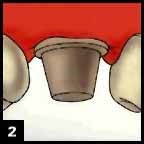 Step 2 Dental Crown