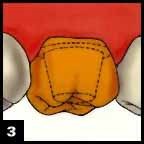 Step 3 Dental Crown